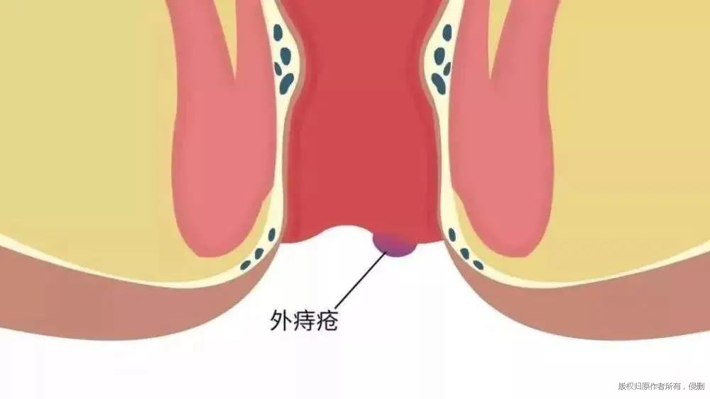 什么是“哨兵痔”？如何预防